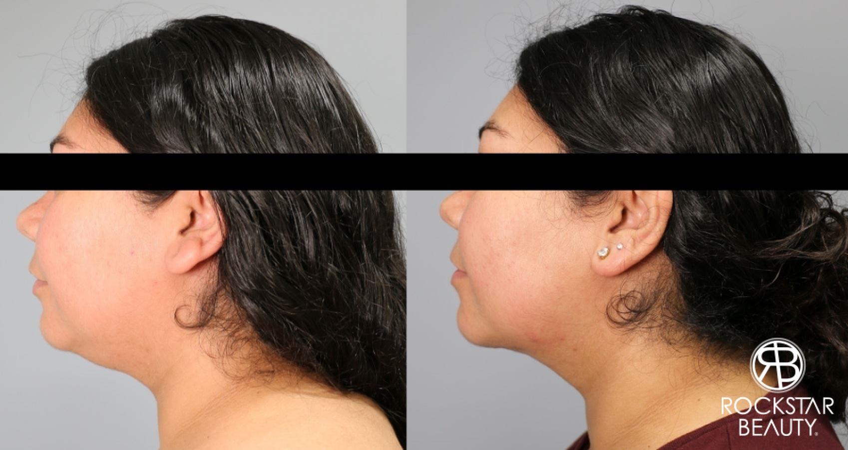 Liposuction Of The Neck: Patient 34 - Before and After 1