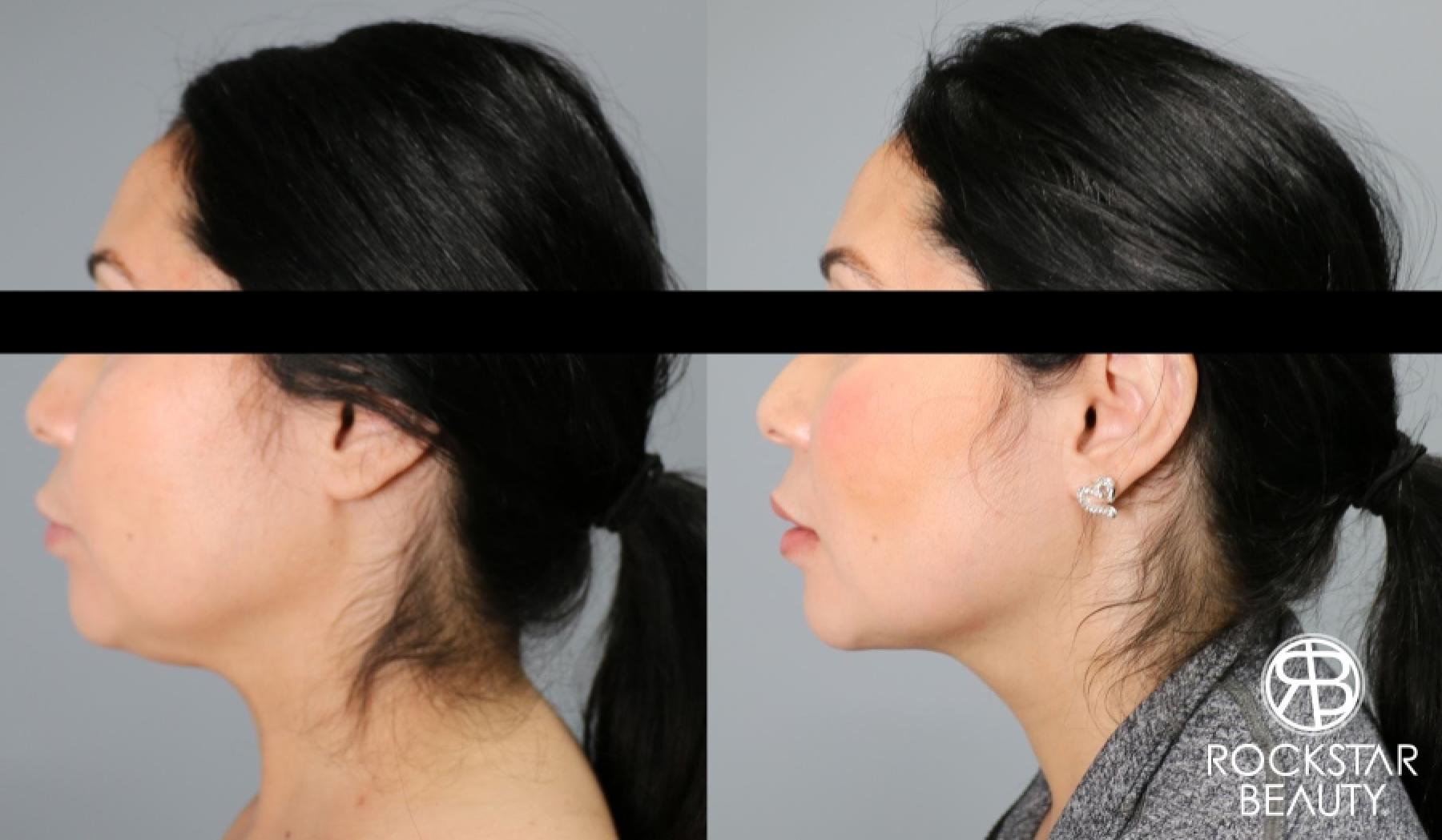 Liposuction Of The Neck: Patient 9 - Before and After  