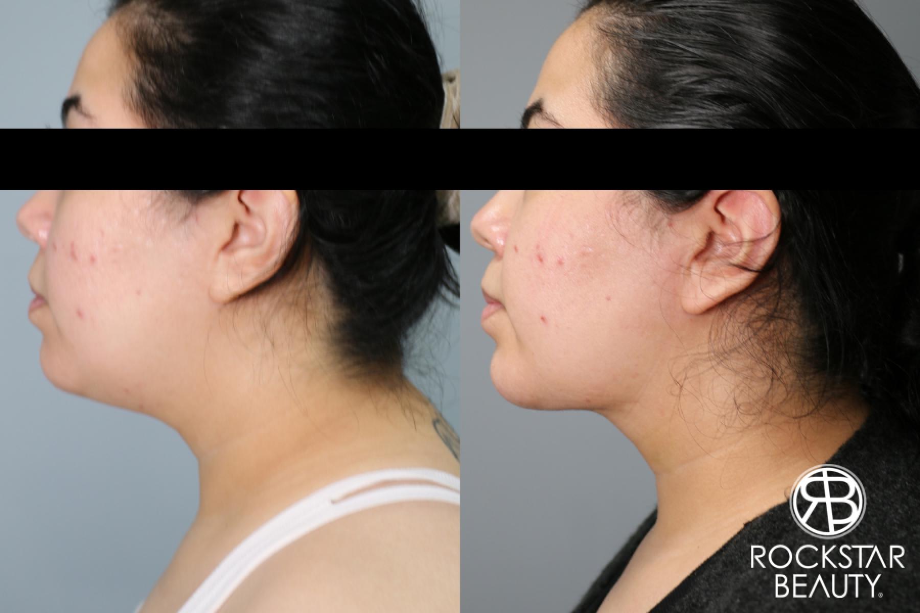 Liposuction Of The Neck: Patient 41 - Before and After 1