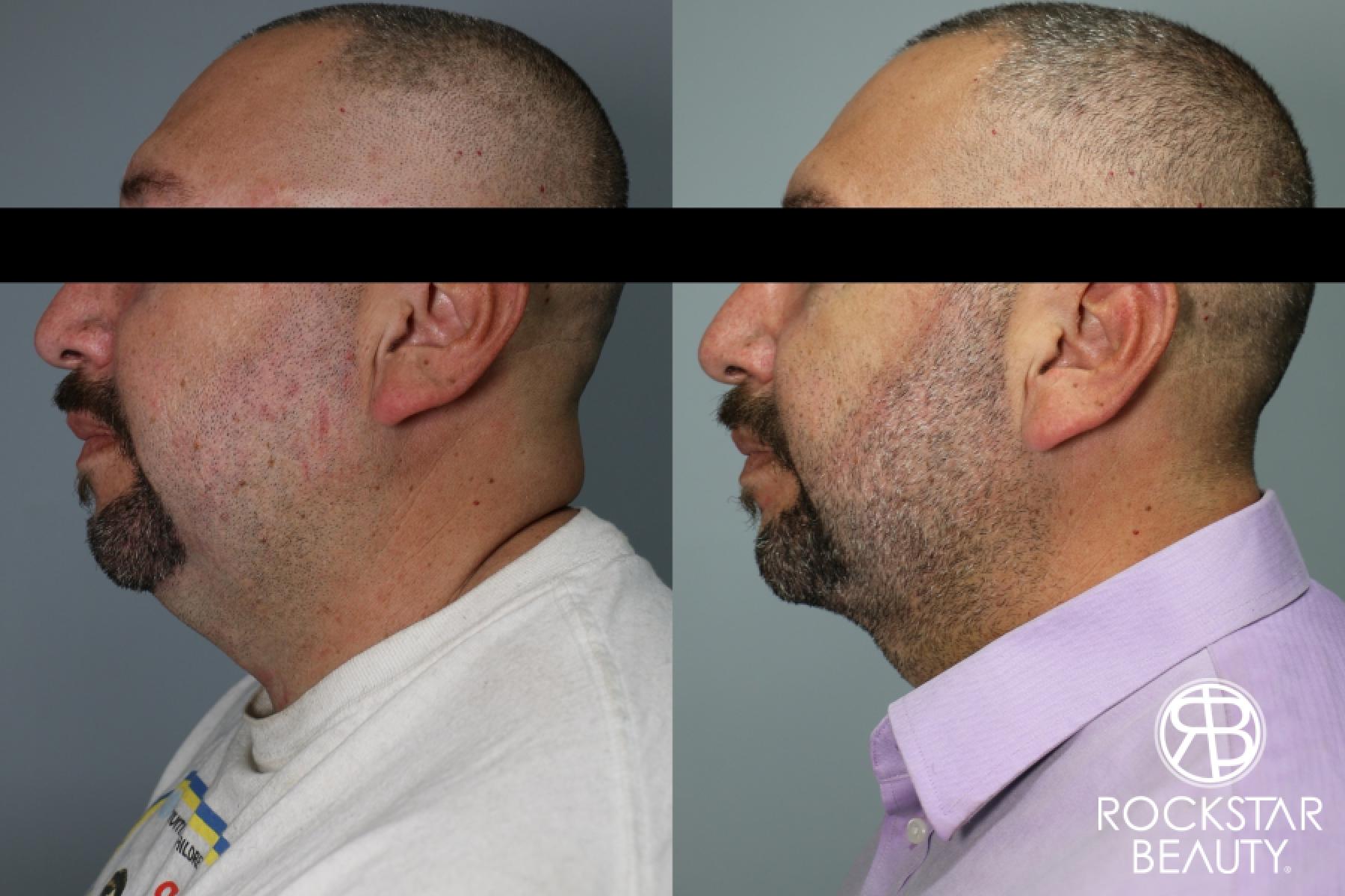 Liposuction Of The Neck: Patient 59 - Before and After 1