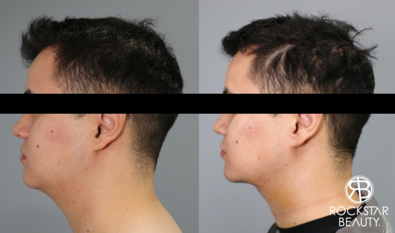 Liposuction Of The Neck: Patient 36 - Before and After 1