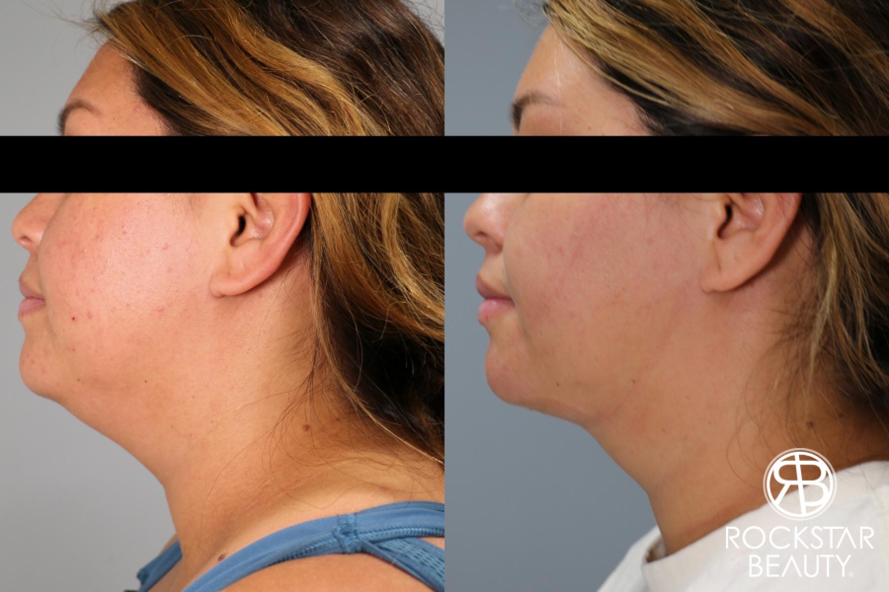 Liposuction Of The Neck: Patient 75 - Before and After 1