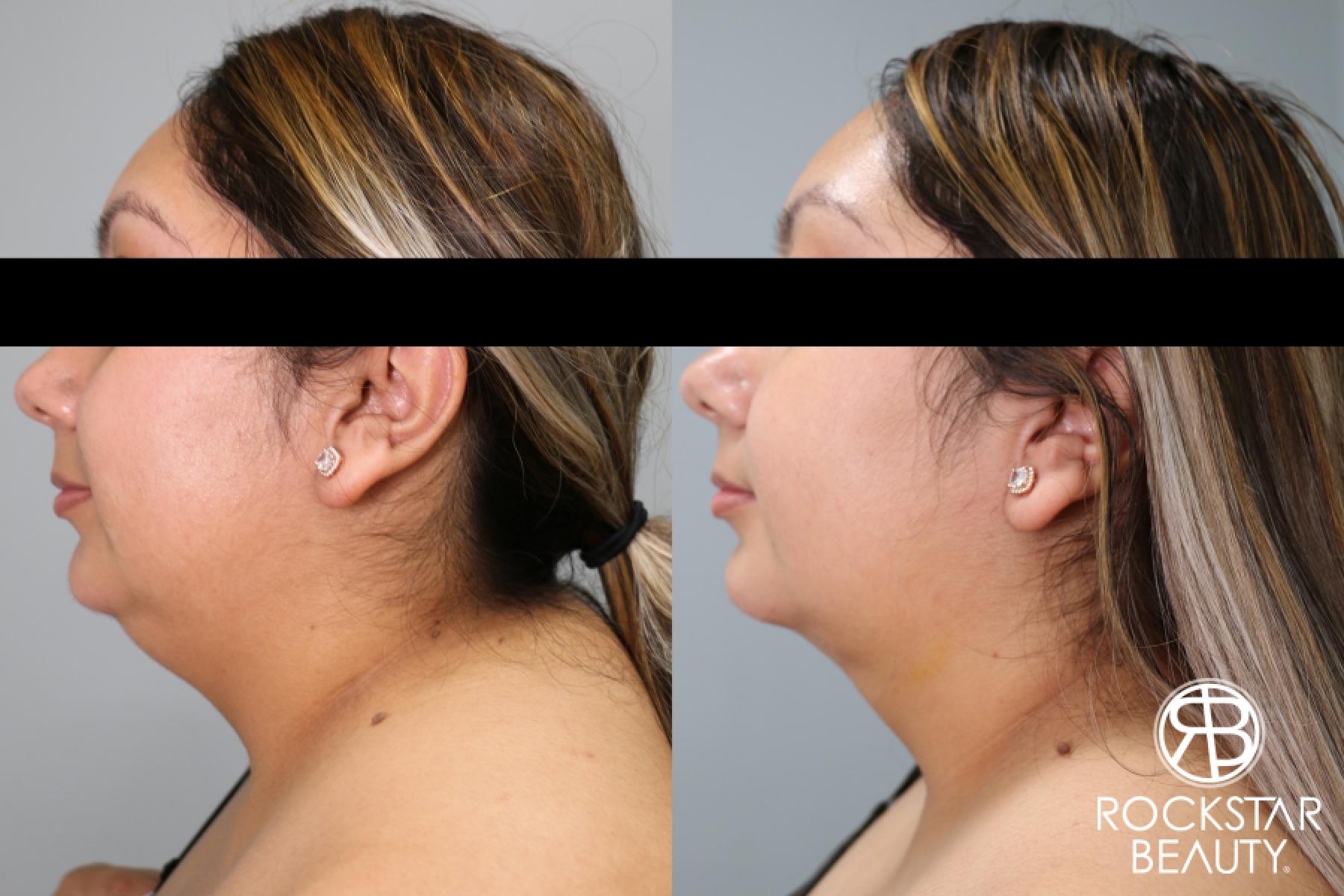 Liposuction Of The Neck: Patient 77 - Before and After 1