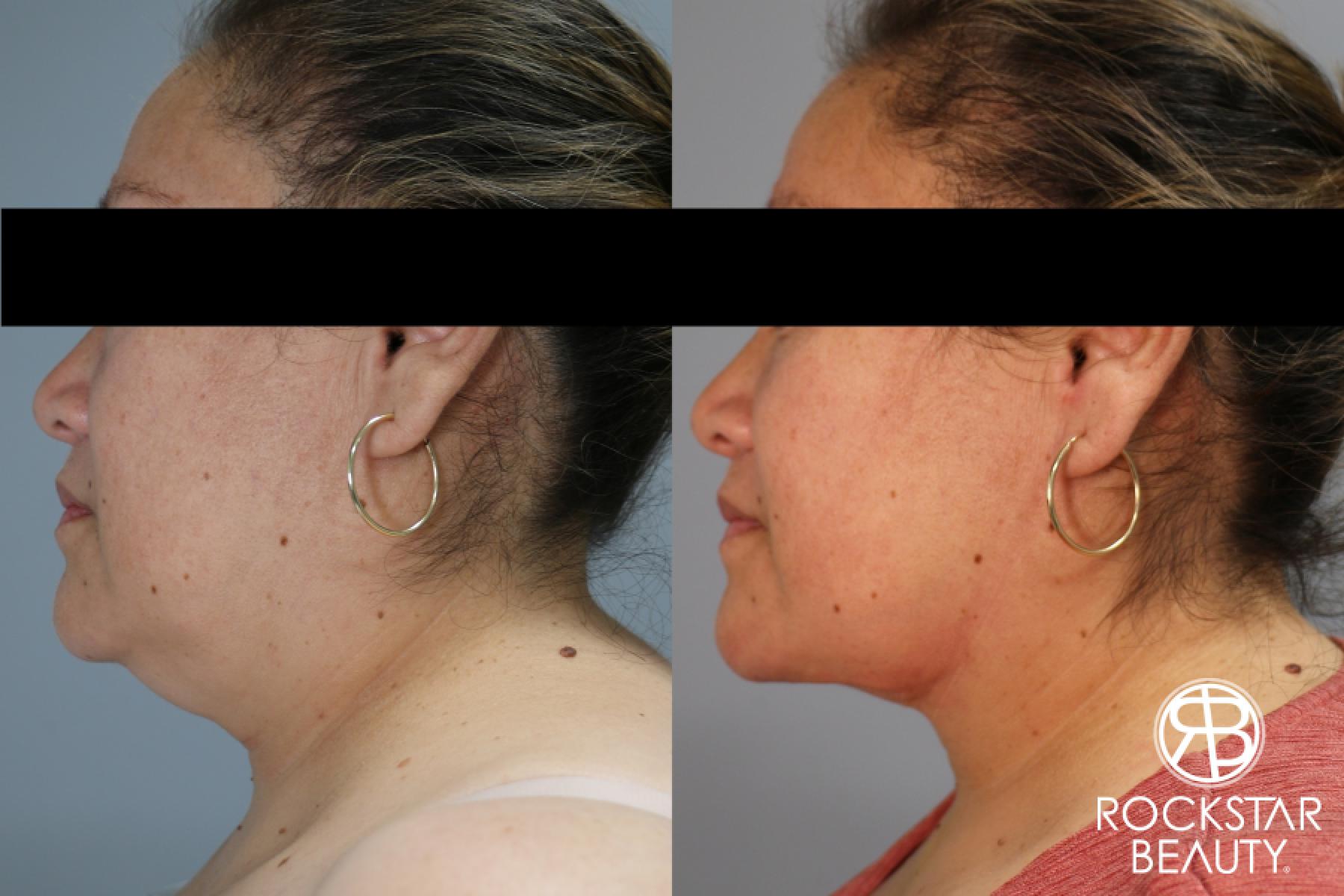 Liposuction Of The Neck: Patient 79 - Before and After 1