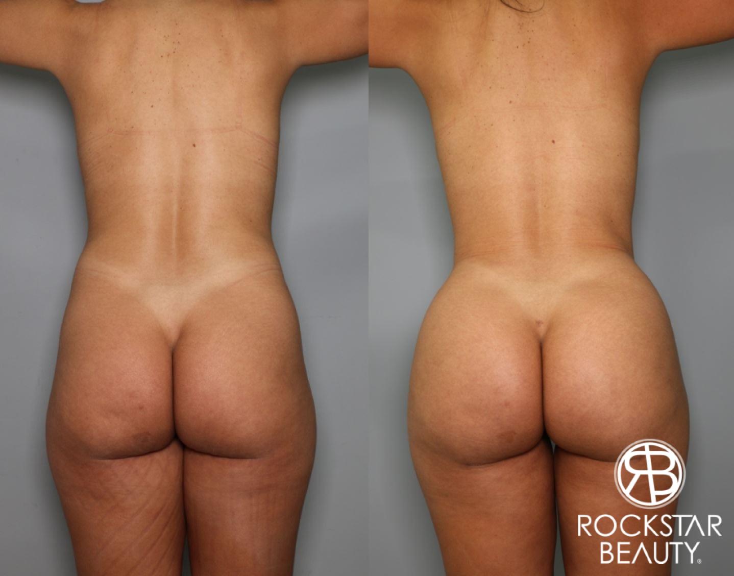 Brazilian Butt Lift: Patient 9 - Before and After  