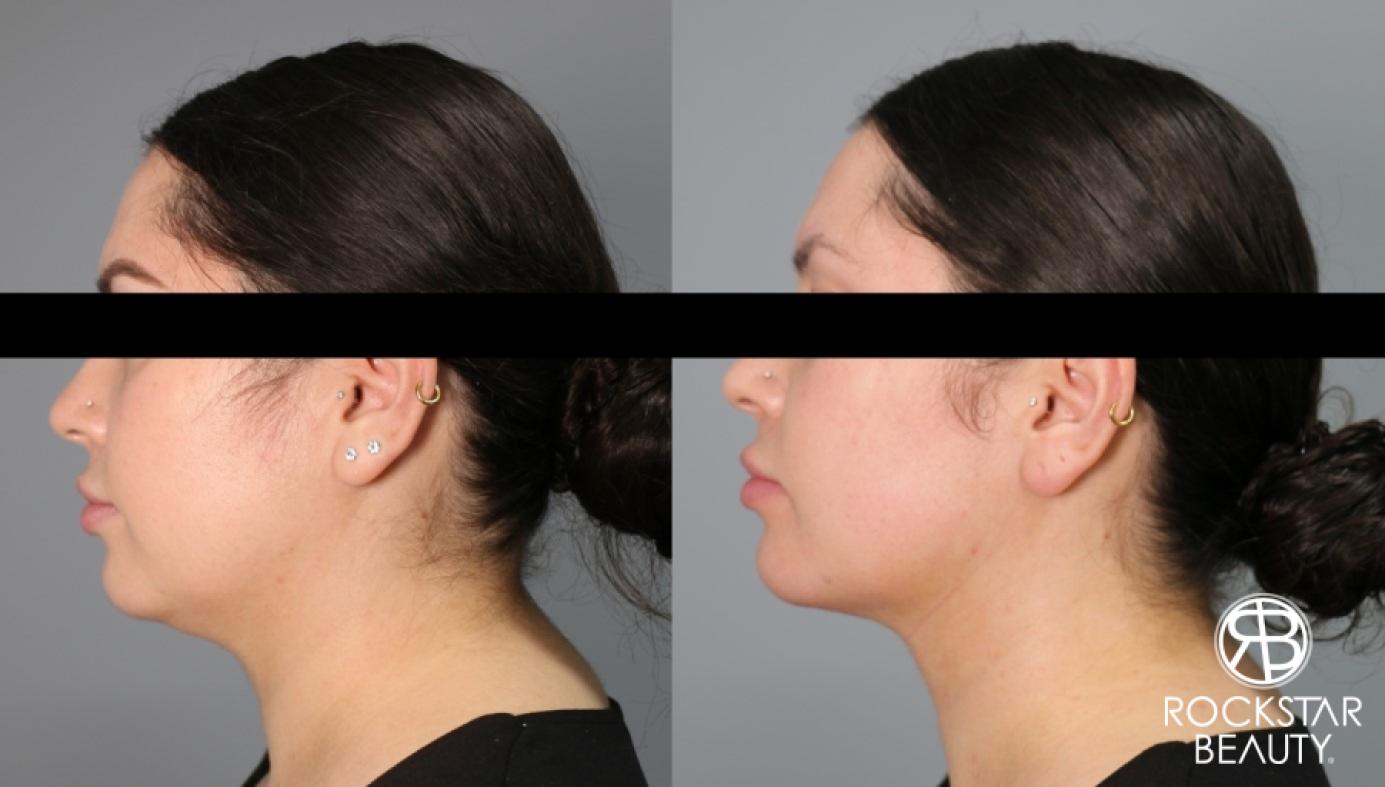 Liposuction Of The Neck: Patient 37 - Before and After 1