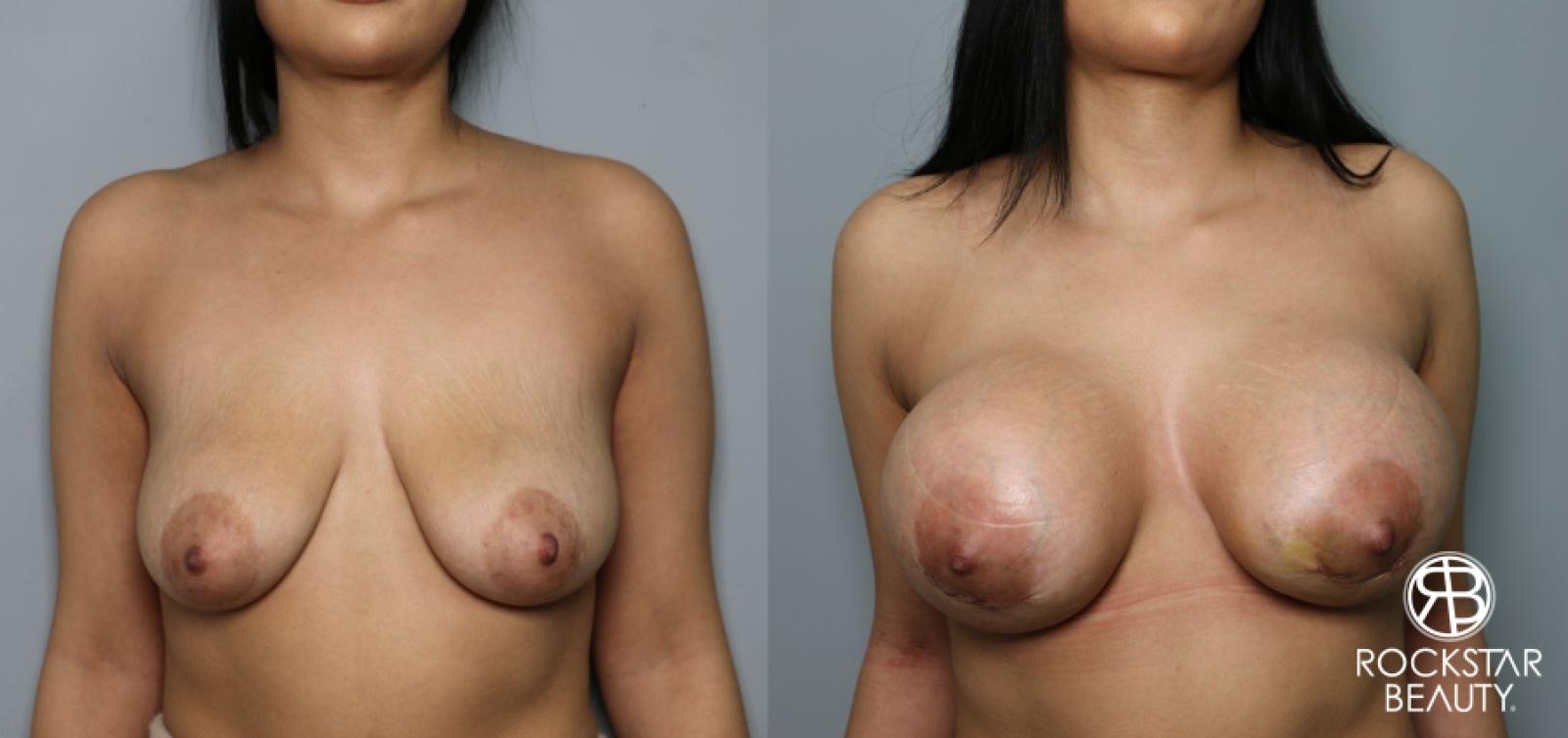 Breast Augmentation: Patient 28 - Before and After 1