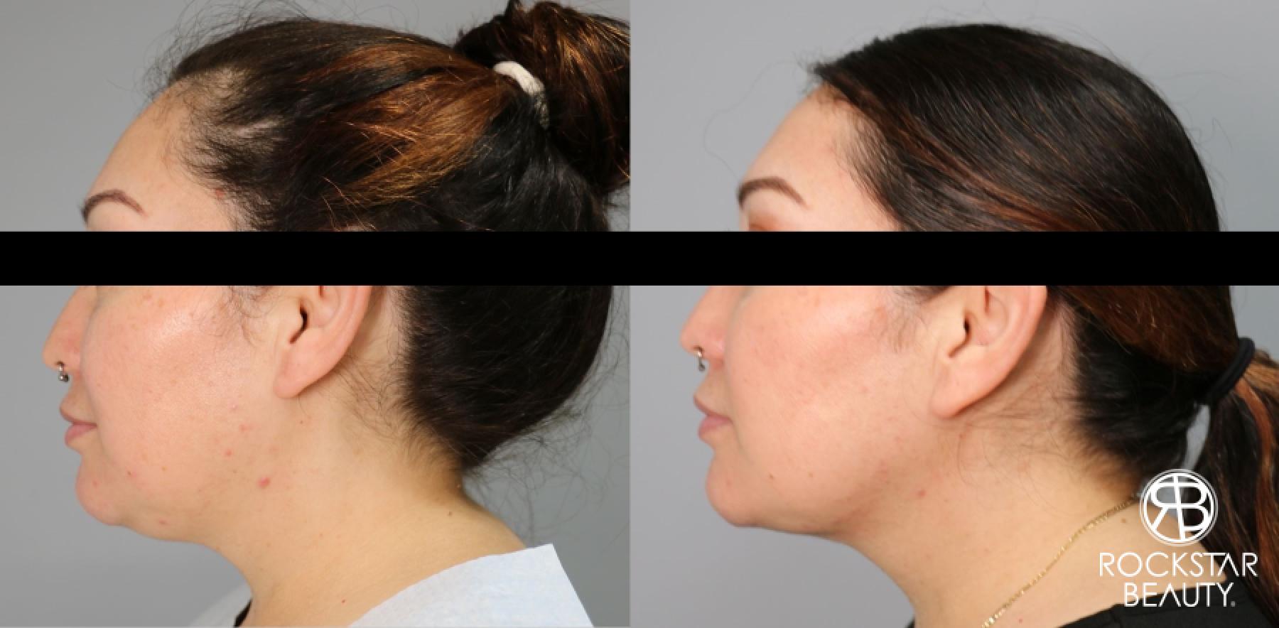 Liposuction Of The Neck: Patient 31 - Before and After 1