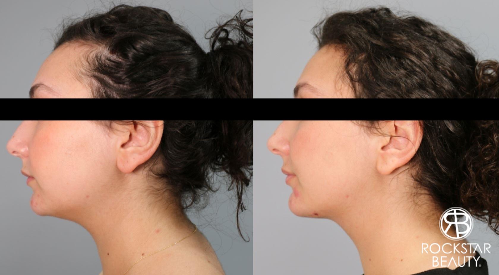 Liposuction Of The Neck: Patient 8 - Before and After  