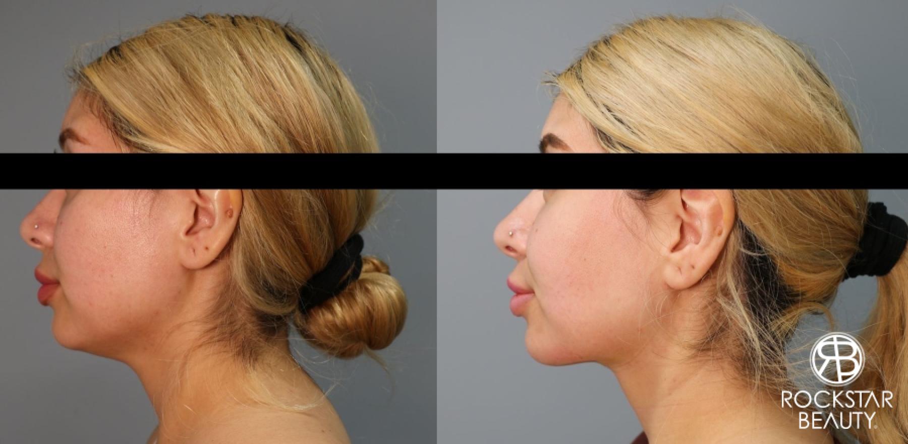 Liposuction Of The Neck: Patient 5 - Before and After  