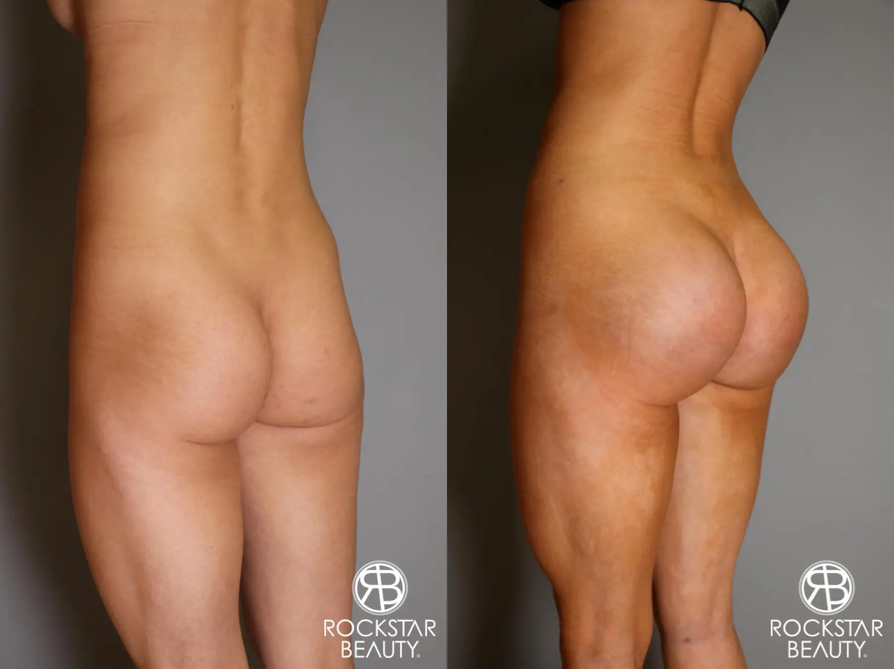 Brazilian Butt Lift: Patient 10 - Before and After 5