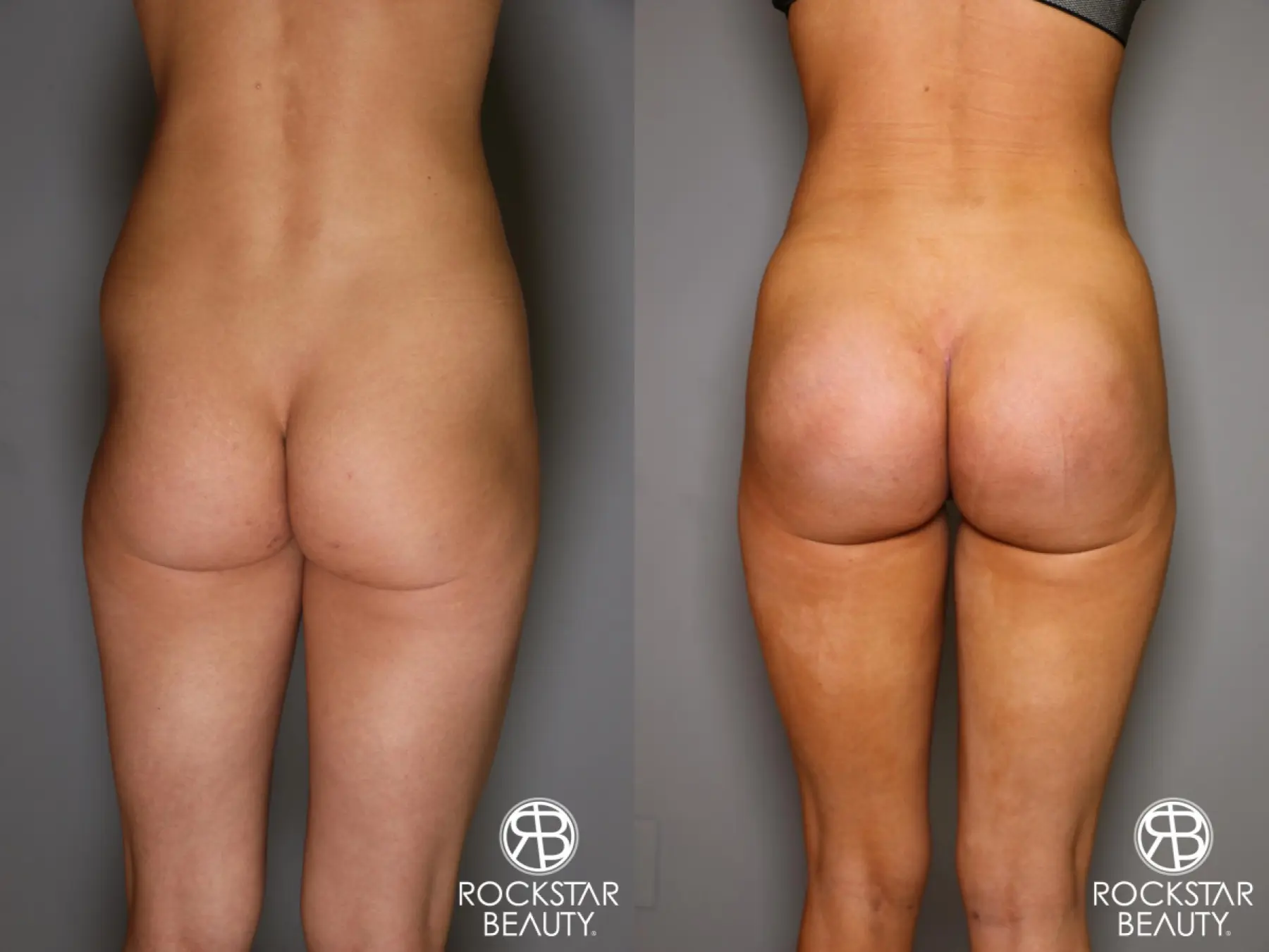 Brazilian Butt Lift: Patient 10 - Before and After 1