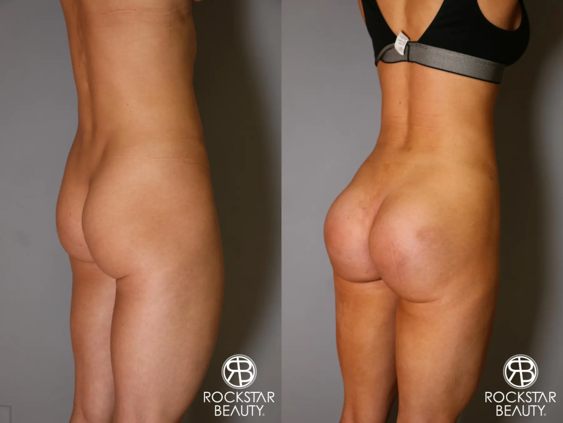 Brazilian Butt Lift: Patient 10 - Before and After 4