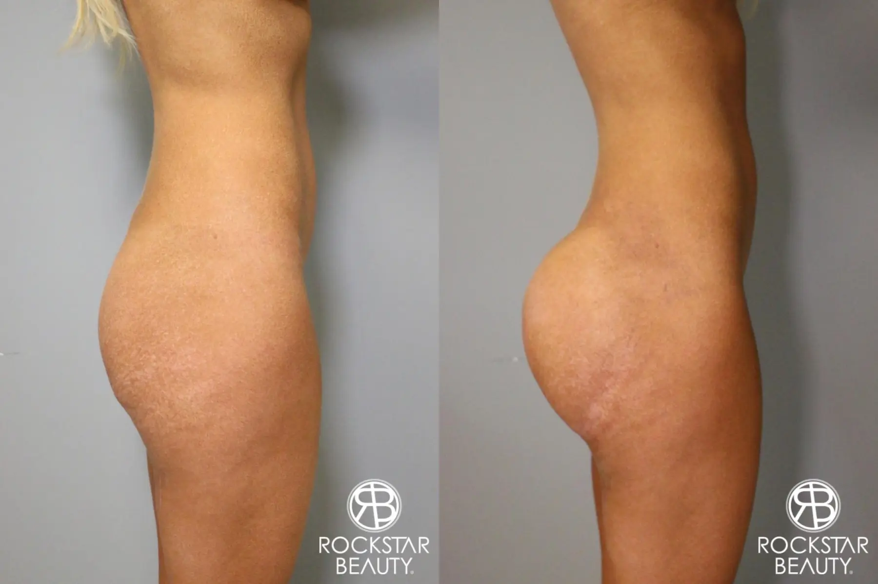 Brazilian Butt Lift: Patient 6 - Before and After 3