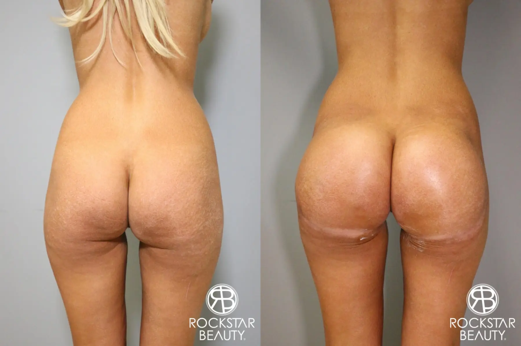 Brazilian Butt Lift: Patient 6 - Before and After  