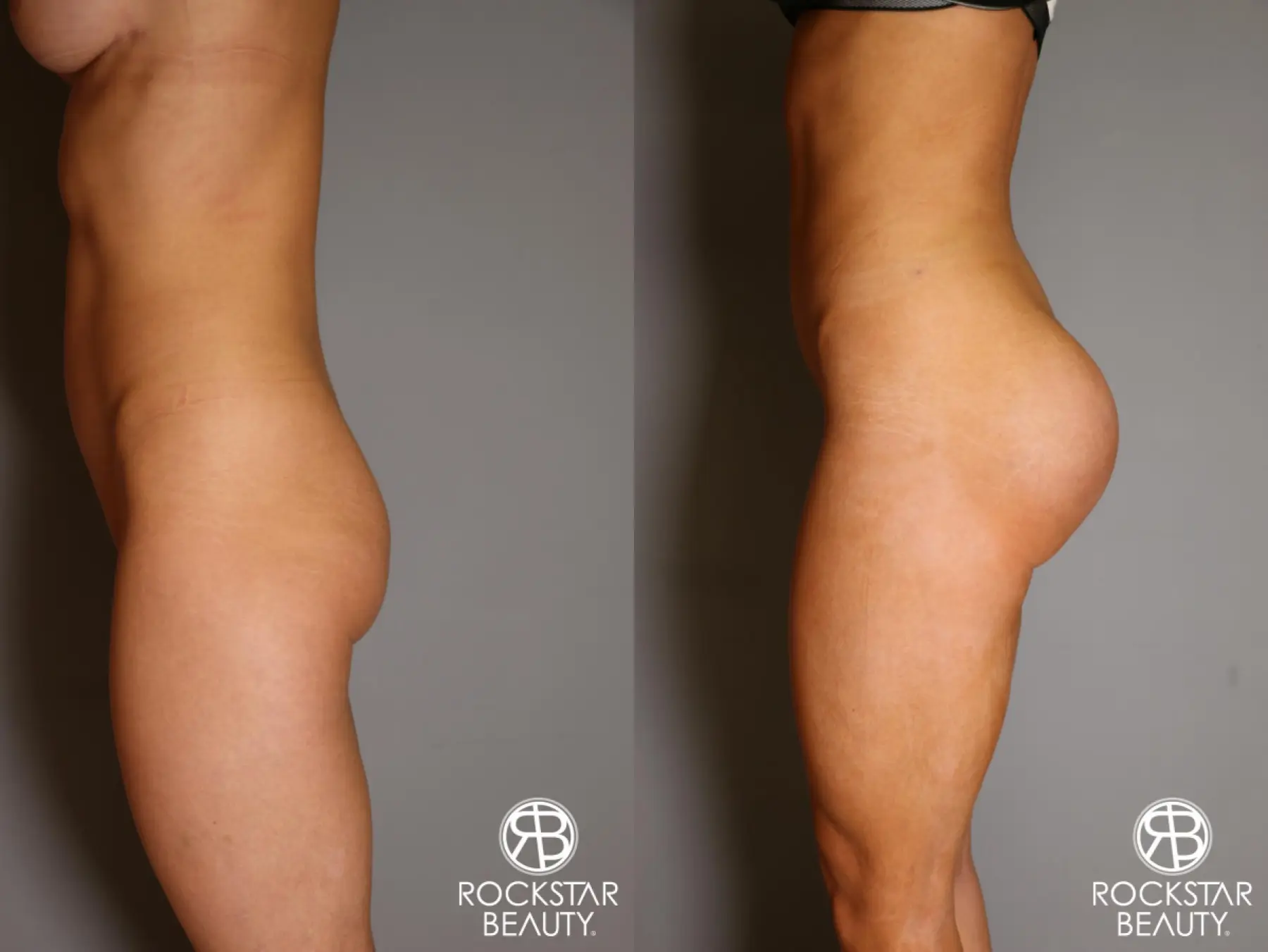 Brazilian Butt Lift: Patient 10 - Before and After 3