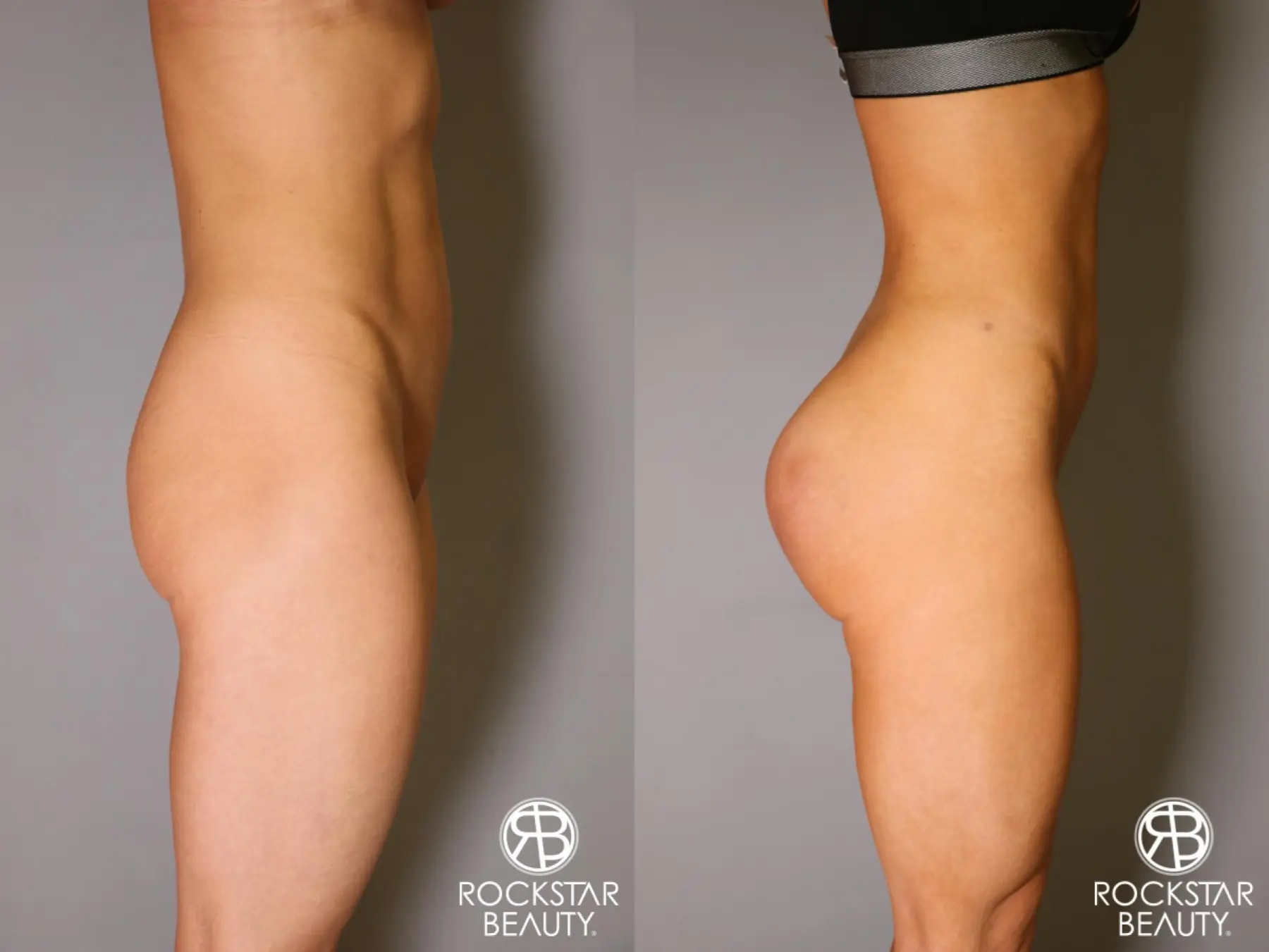 Brazilian Butt Lift: Patient 10 - Before and After 2