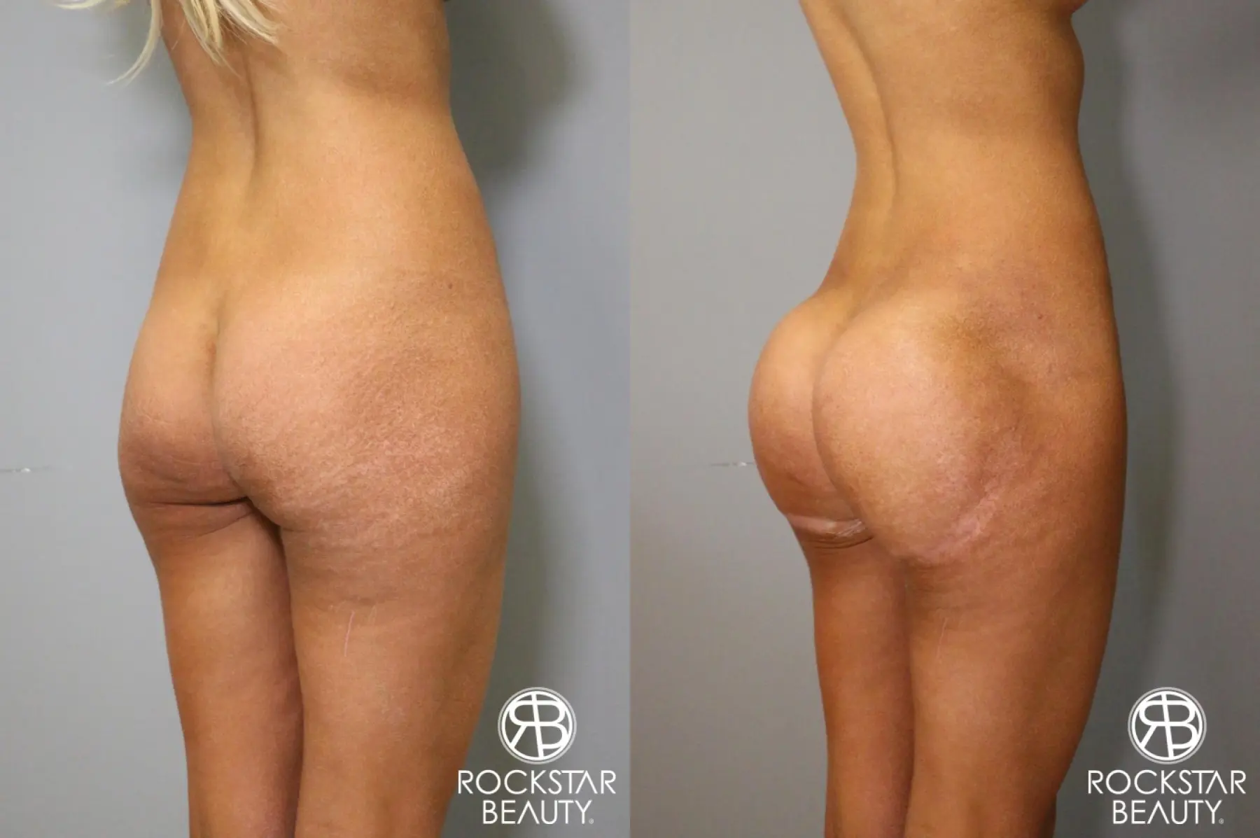 Brazilian Butt Lift: Patient 6 - Before and After 2