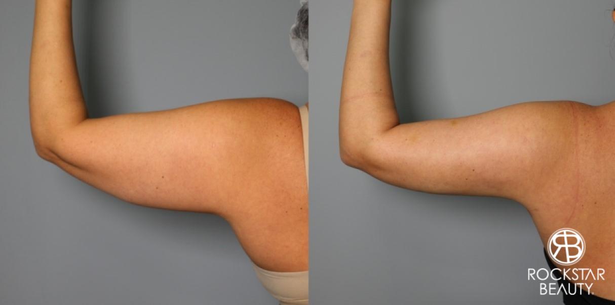 Liposuction: Patient 9 - Before and After  