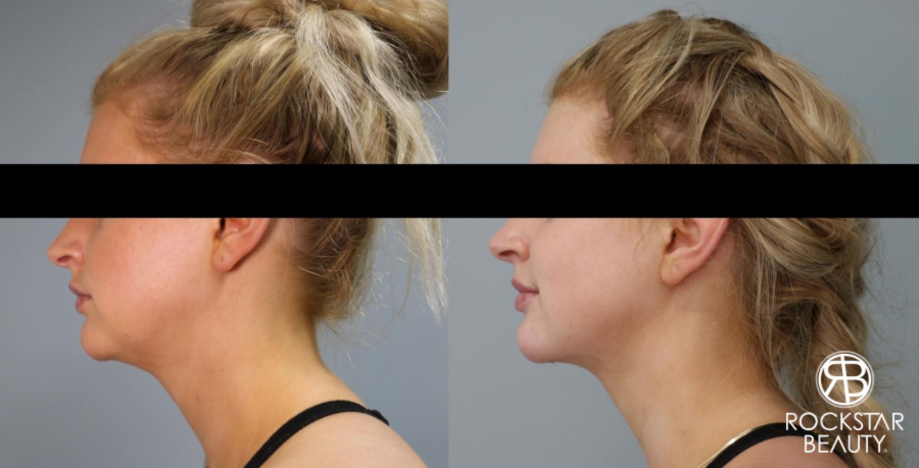 Liposuction Of The Neck: Patient 56 - Before and After 1