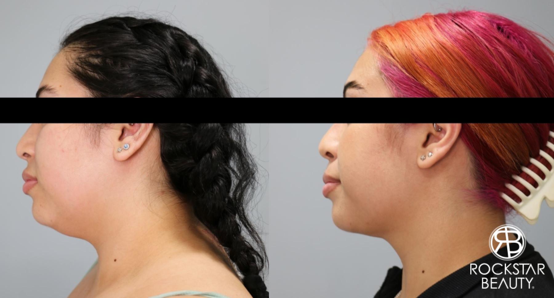 Liposuction Of The Neck: Patient 58 - Before and After 1