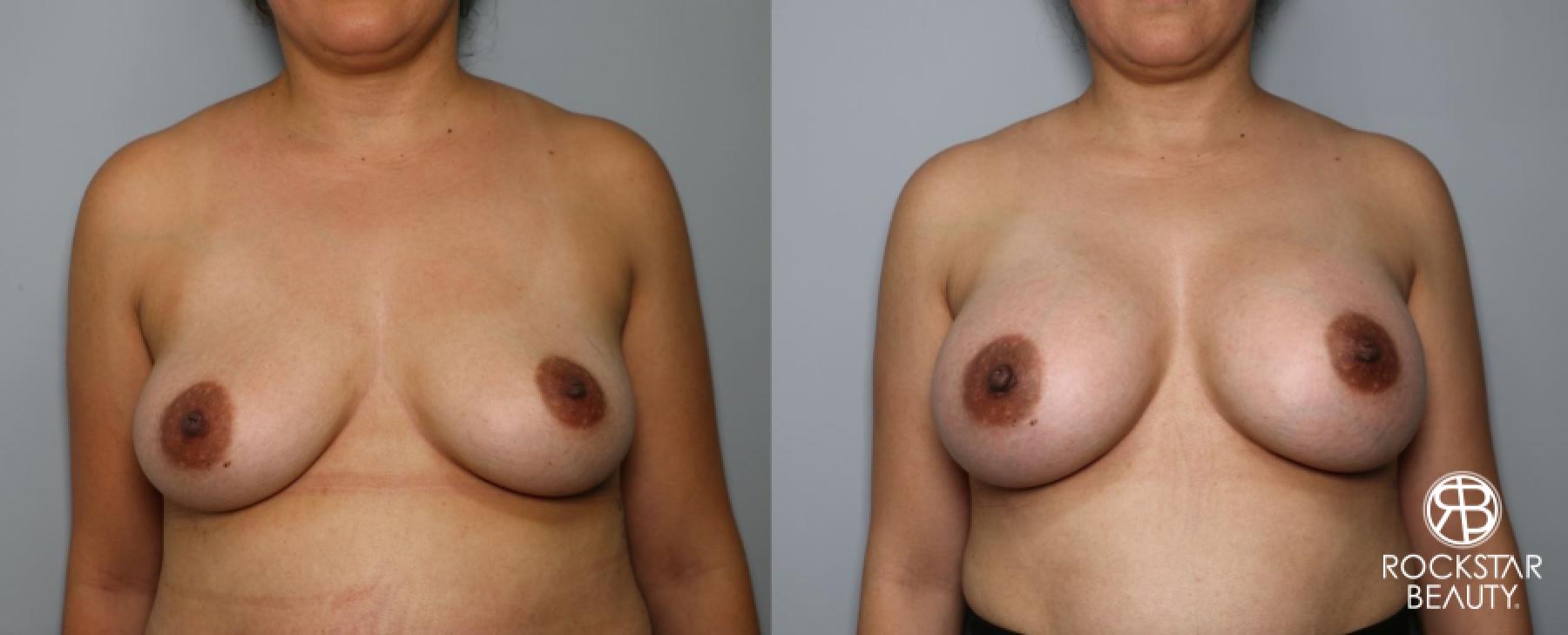 Breast Augmentation: Patient 11 - Before and After 1