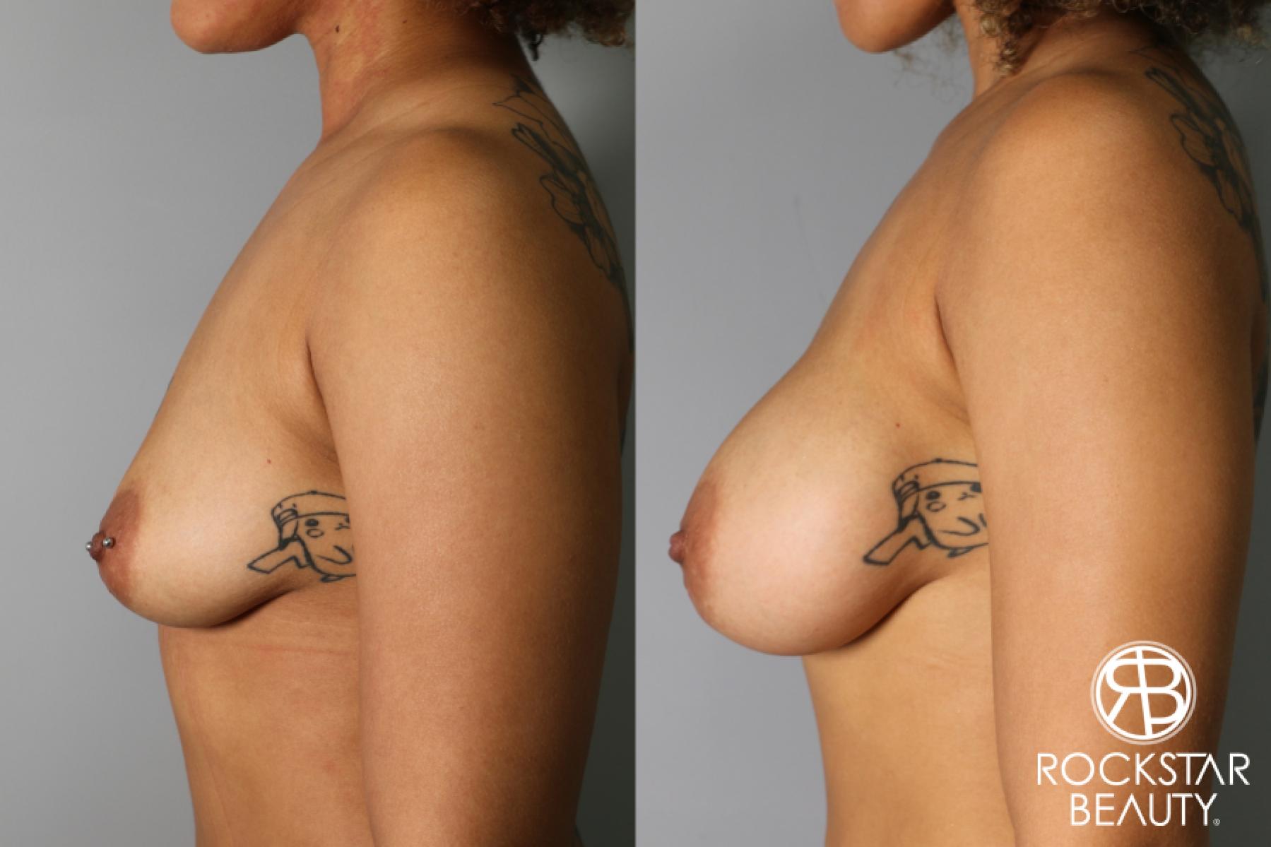 Breast Augmentation: Patient 36 - Before and After 3