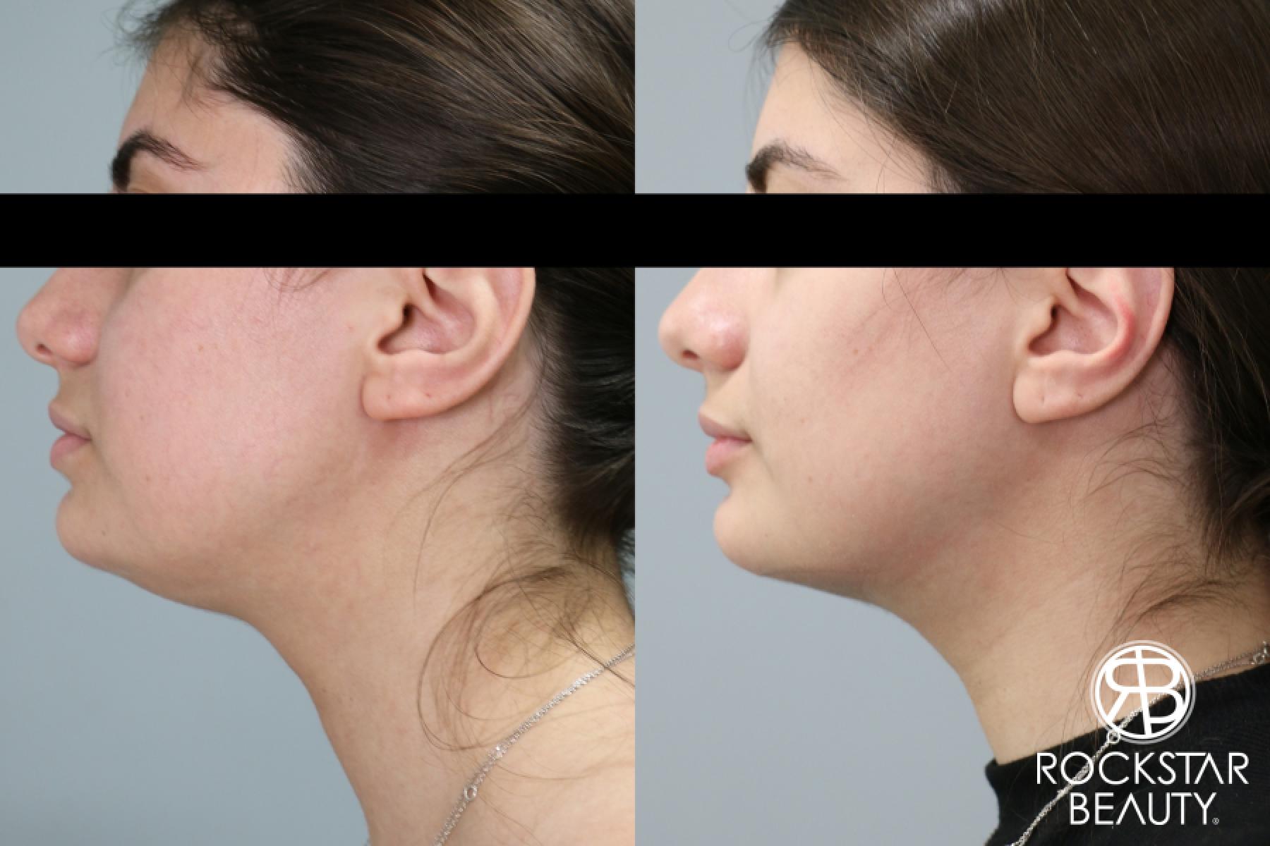 Liposuction Of The Neck: Patient 74 - Before and After 1