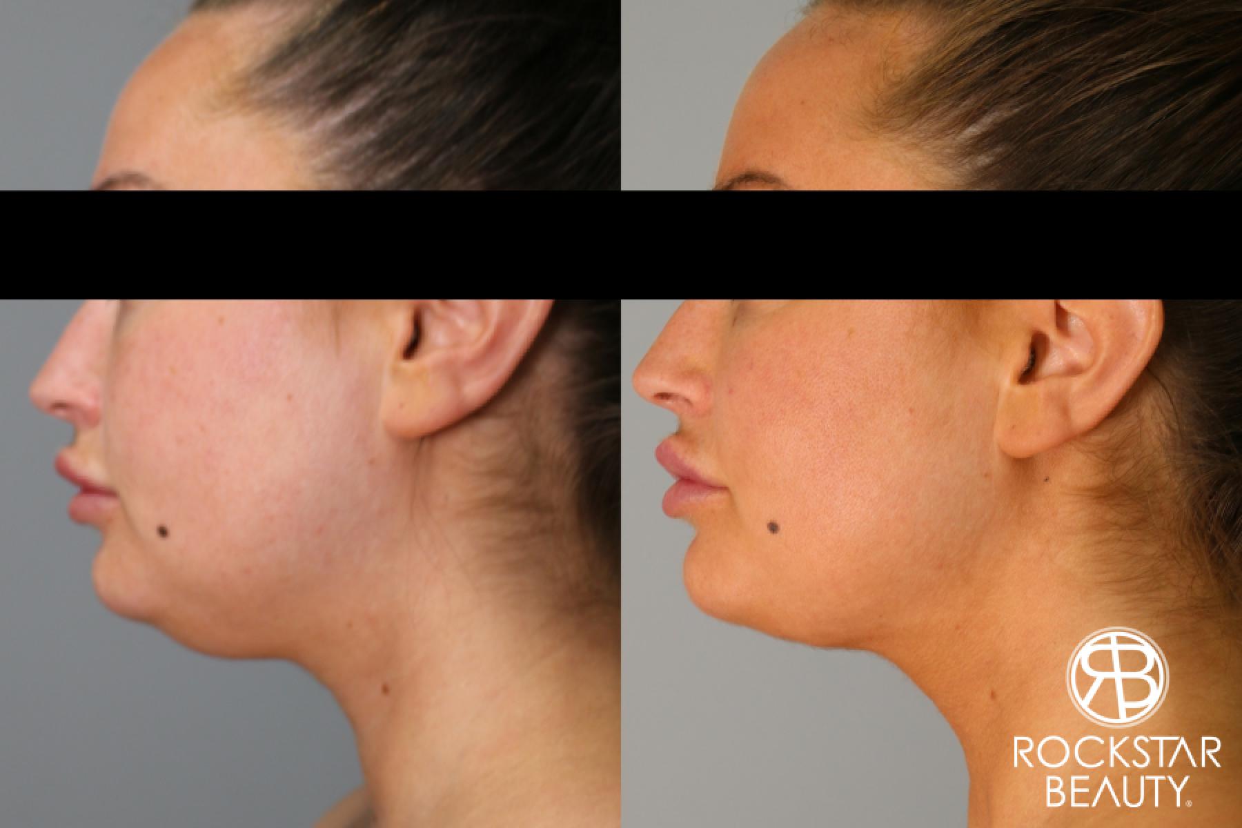 Liposuction Of The Neck: Patient 45 - Before and After 1