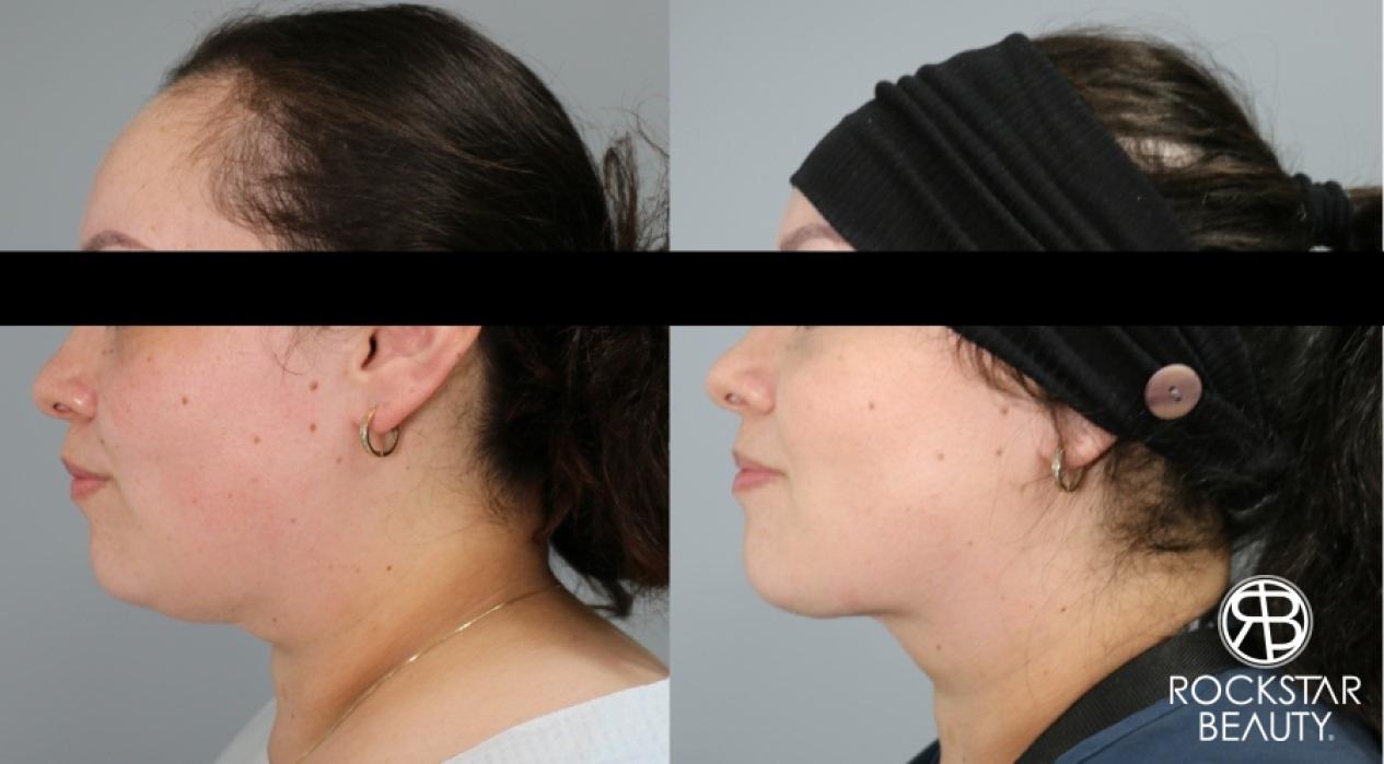 Liposuction Of The Neck: Patient 28 - Before and After 1