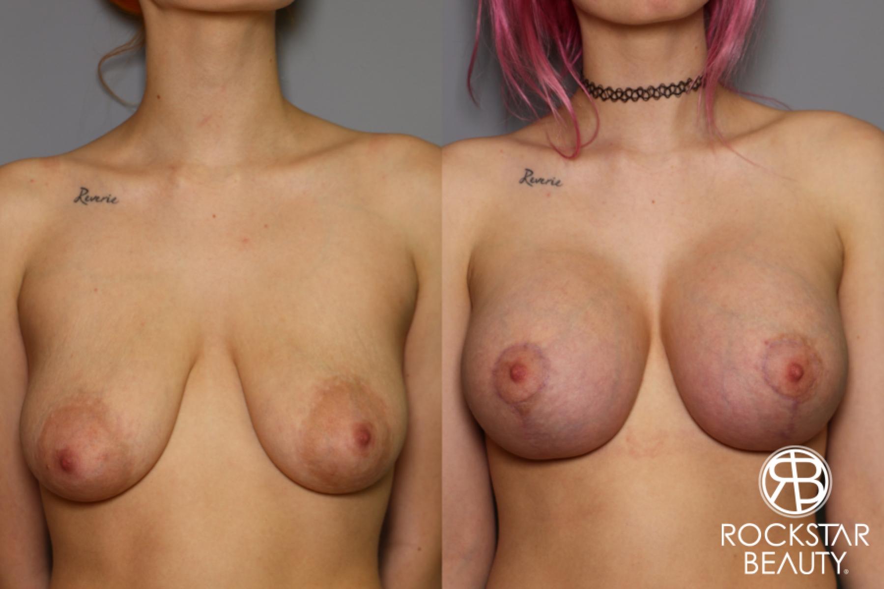 Breast Augmentation With Lift: Patient 1 - Before and After  