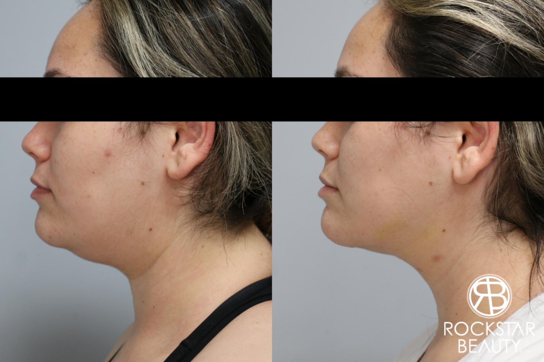 Liposuction Of The Neck: Patient 44 - Before and After 1