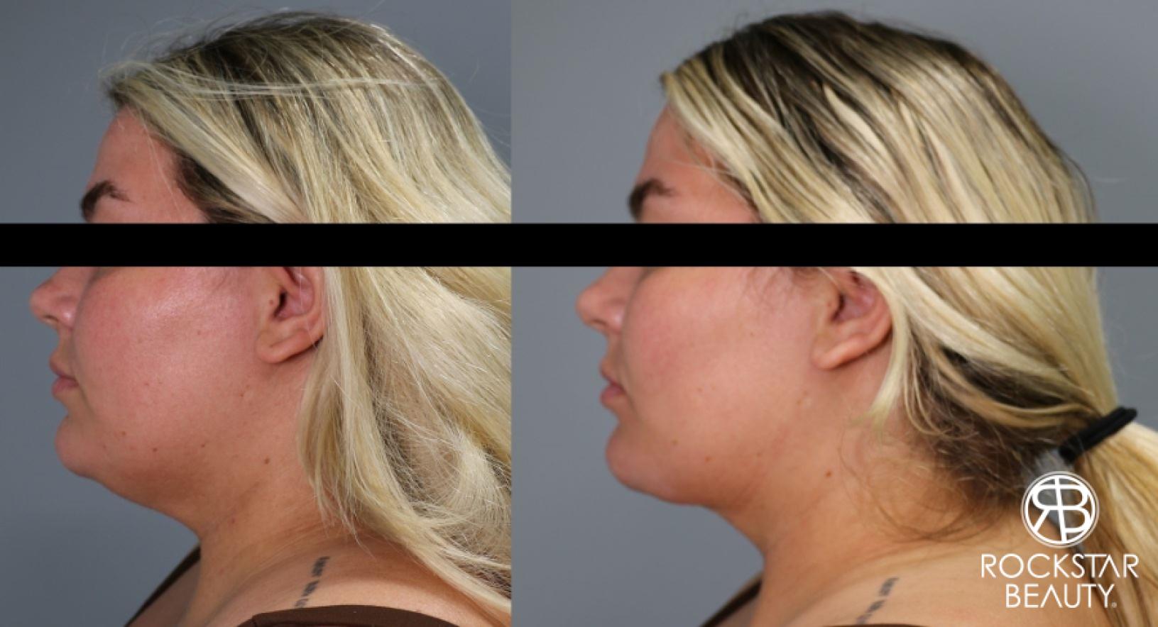 Liposuction Of The Neck: Patient 24 - Before and After 1