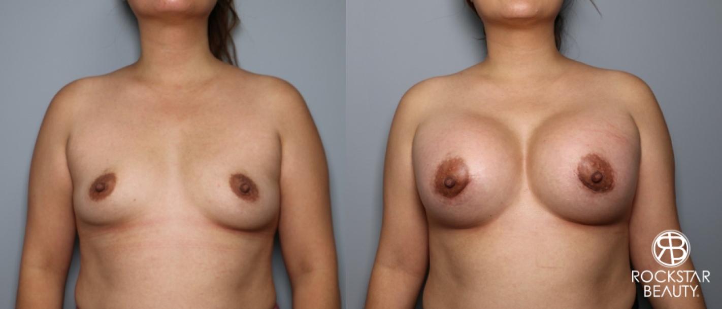 Breast Augmentation: Patient 29 - Before and After 1