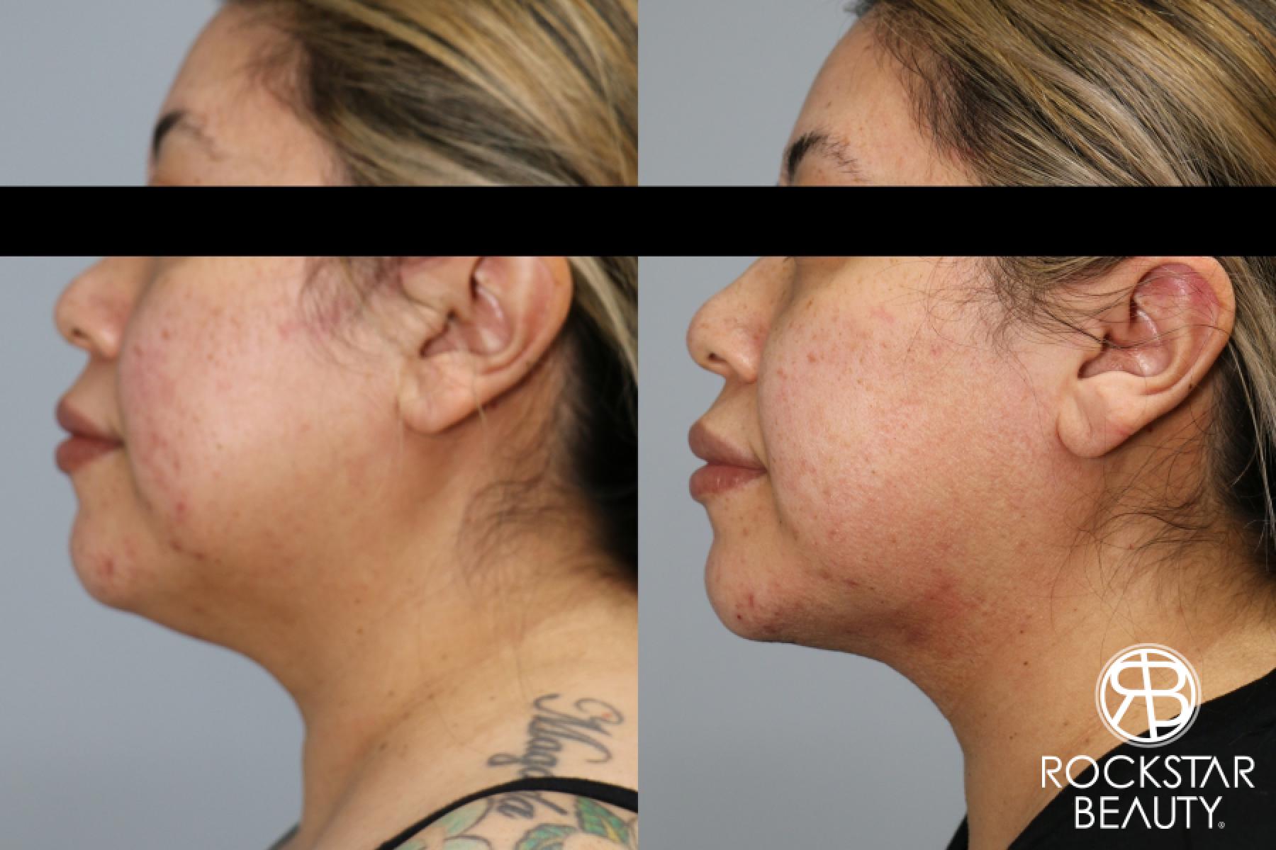 Liposuction Of The Neck: Patient 66 - Before and After 1