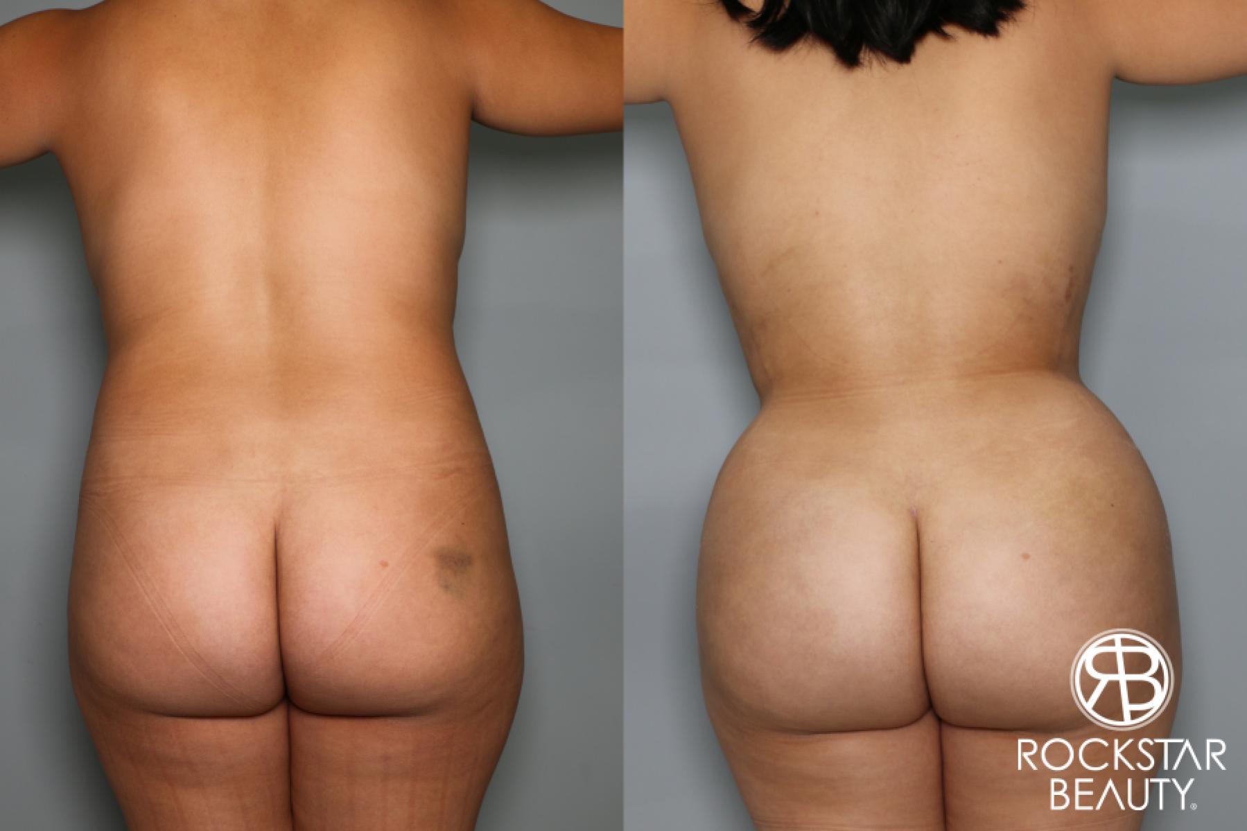 Brazilian Butt Lift: Patient 10 - Before and After  