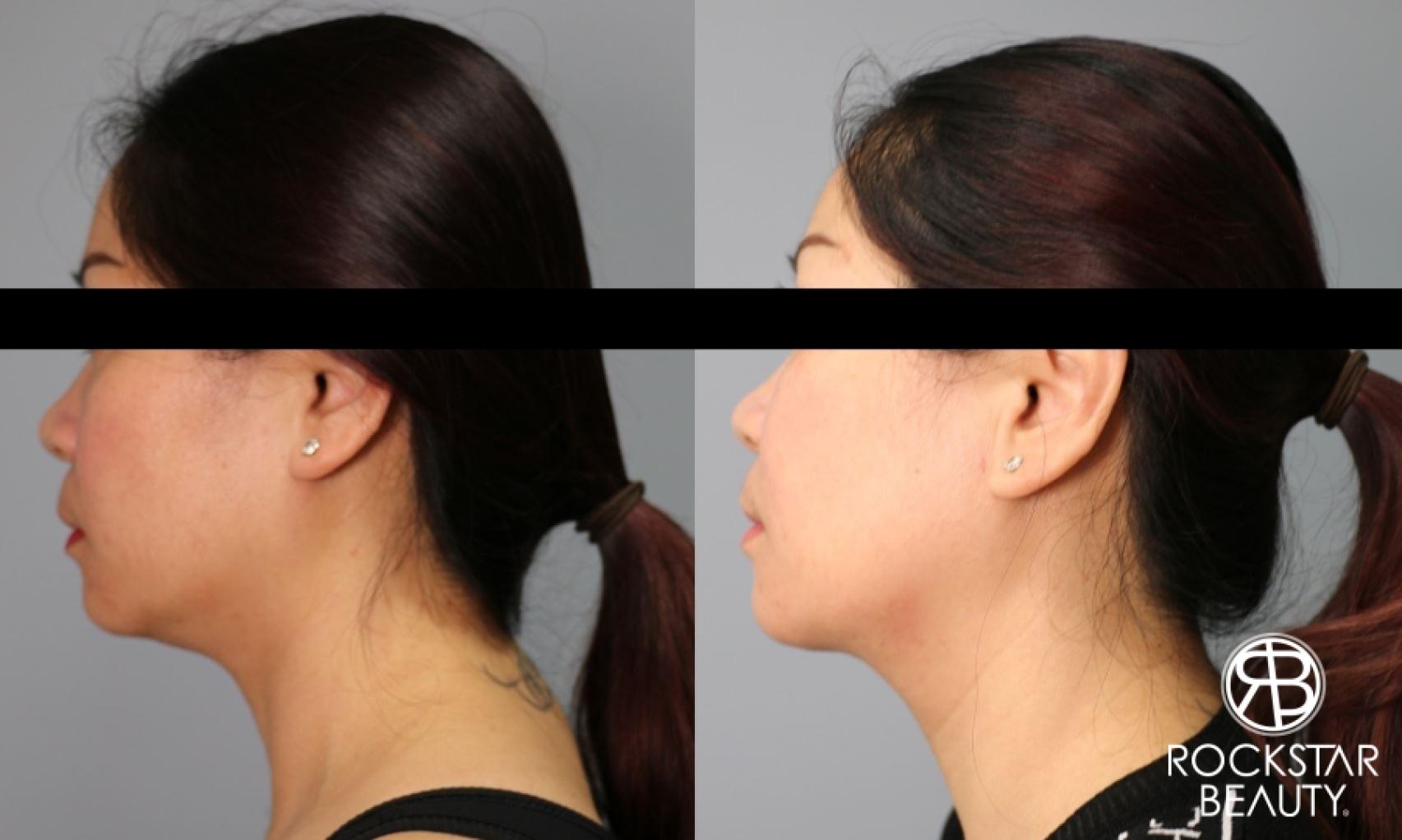 Liposuction Of The Neck: Patient 32 - Before and After 1