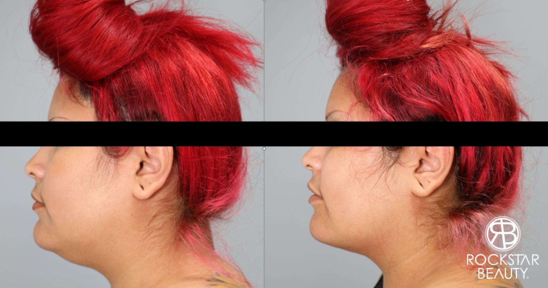 Liposuction Of The Neck: Patient 3 - Before and After 1