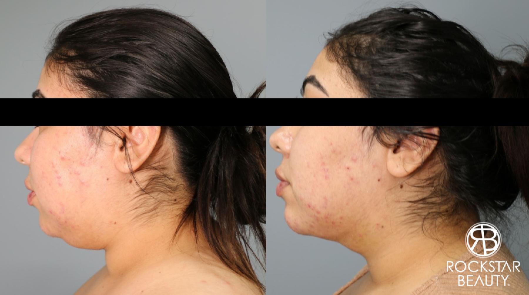 Liposuction Of The Neck: Patient 11 - Before and After 1