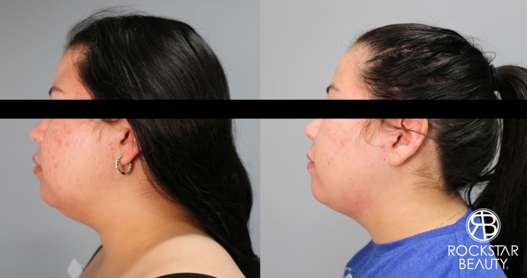 Liposuction Of The Neck: Patient 72 - Before and After 1