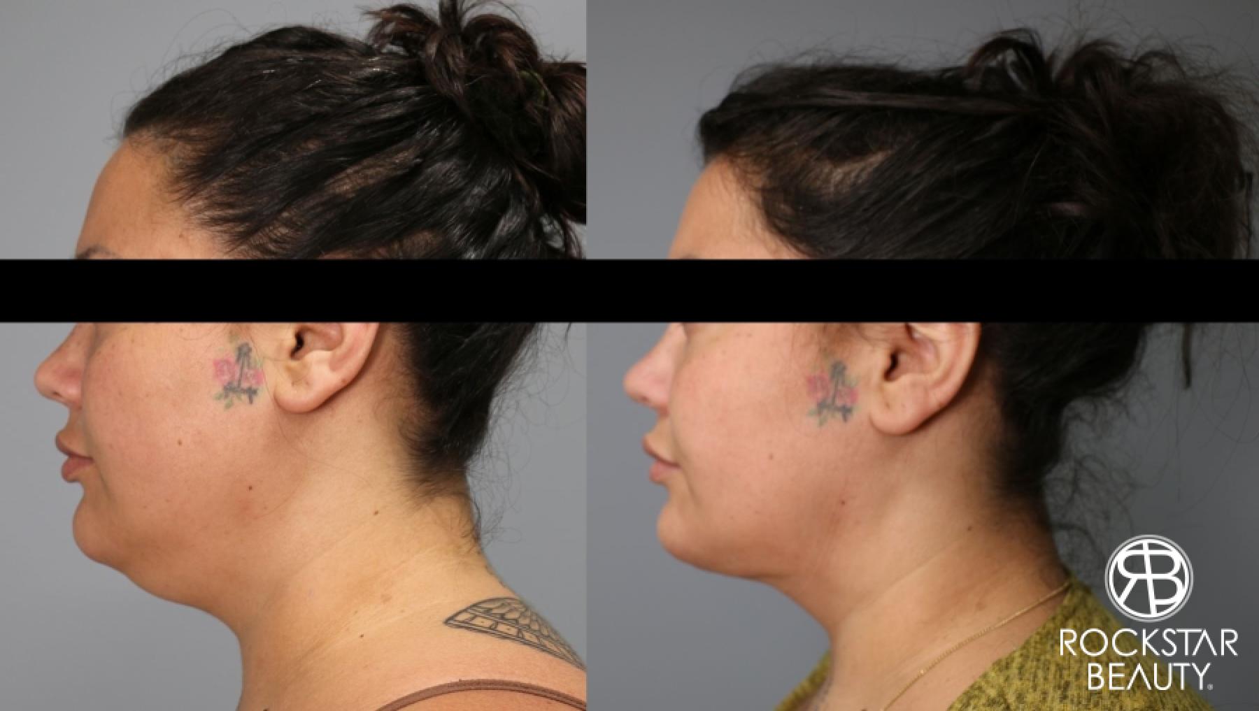 Liposuction Of The Neck: Patient 39 - Before and After 1