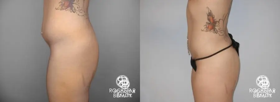 Liposuction: Patient 8 - Before and After 3