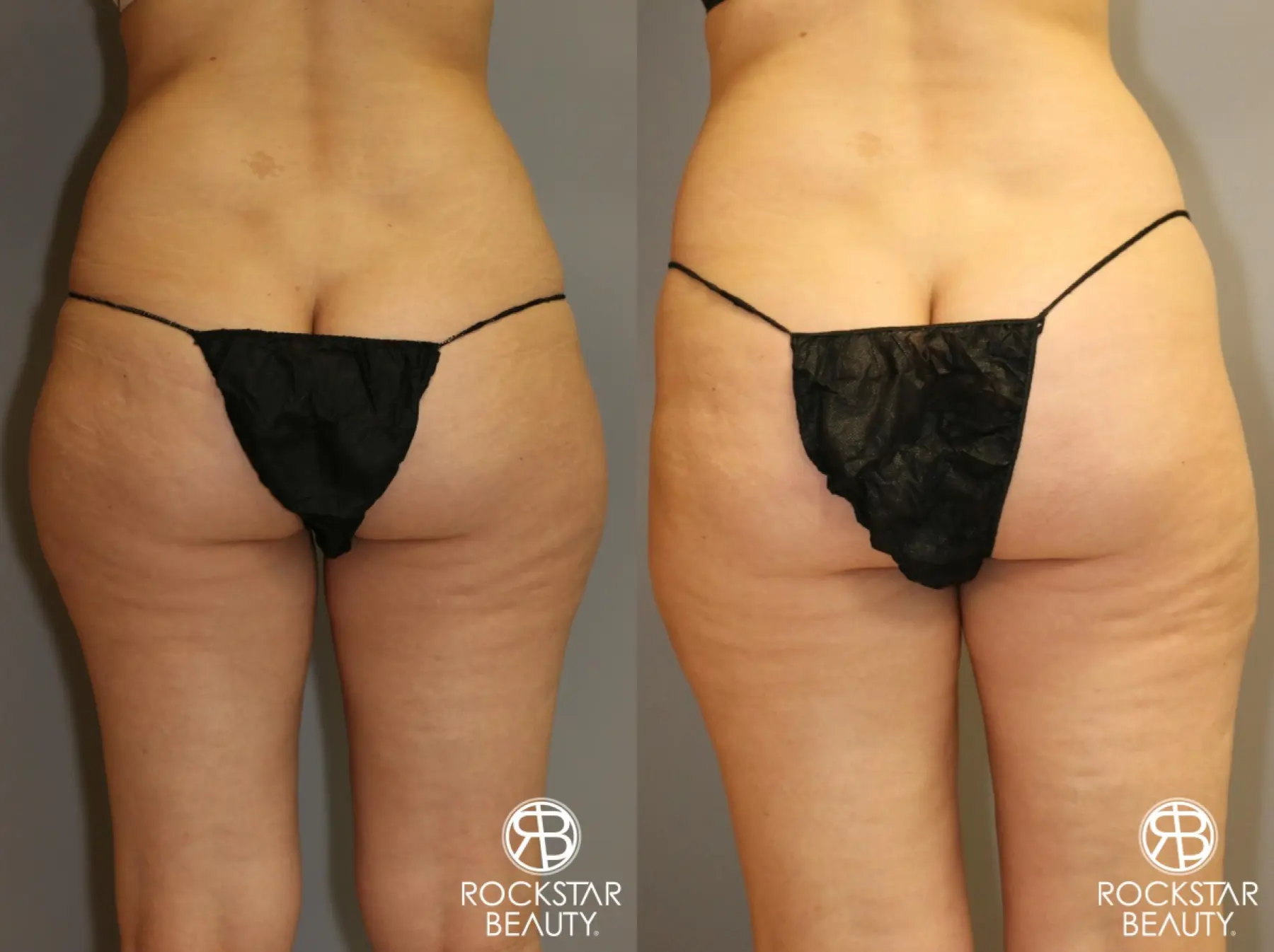 Liposuction: Patient 6 - Before and After 2