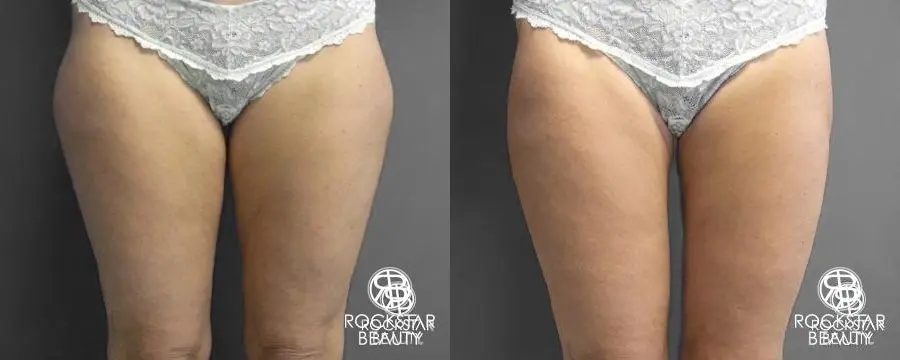 Liposuction: Patient 14 - Before and After 1