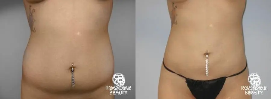 Liposuction: Patient 8 - Before and After  