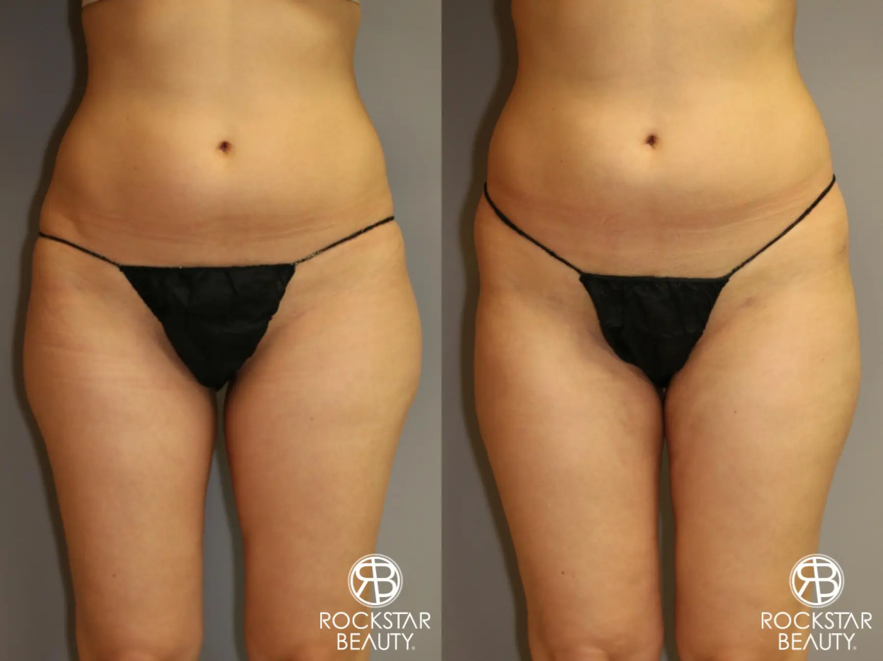 Liposuction: Patient 6 - Before and After  