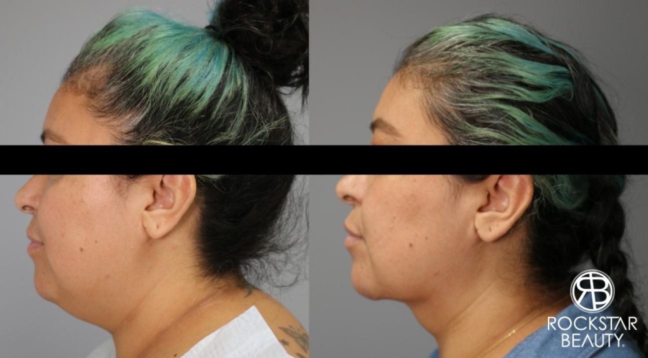 Liposuction Of The Neck: Patient 13 - Before and After 1