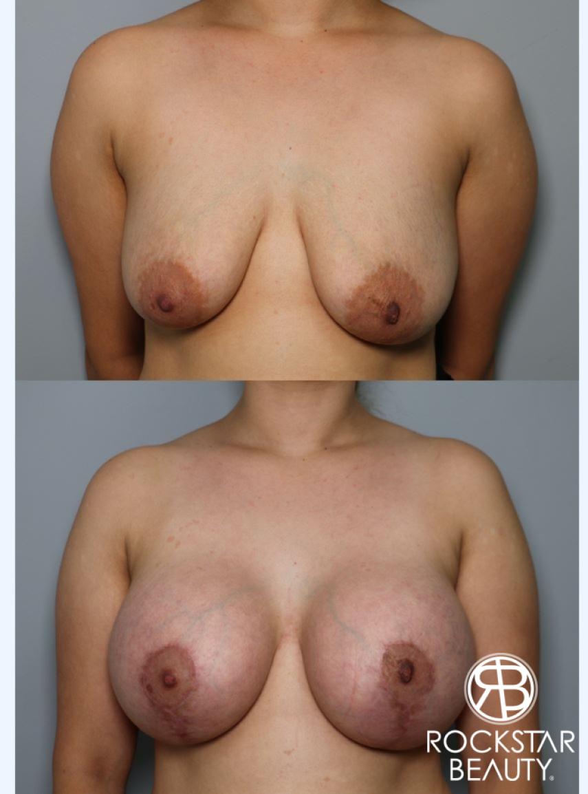 Breast Augmentation With Lift: Patient 3 - Before and After  