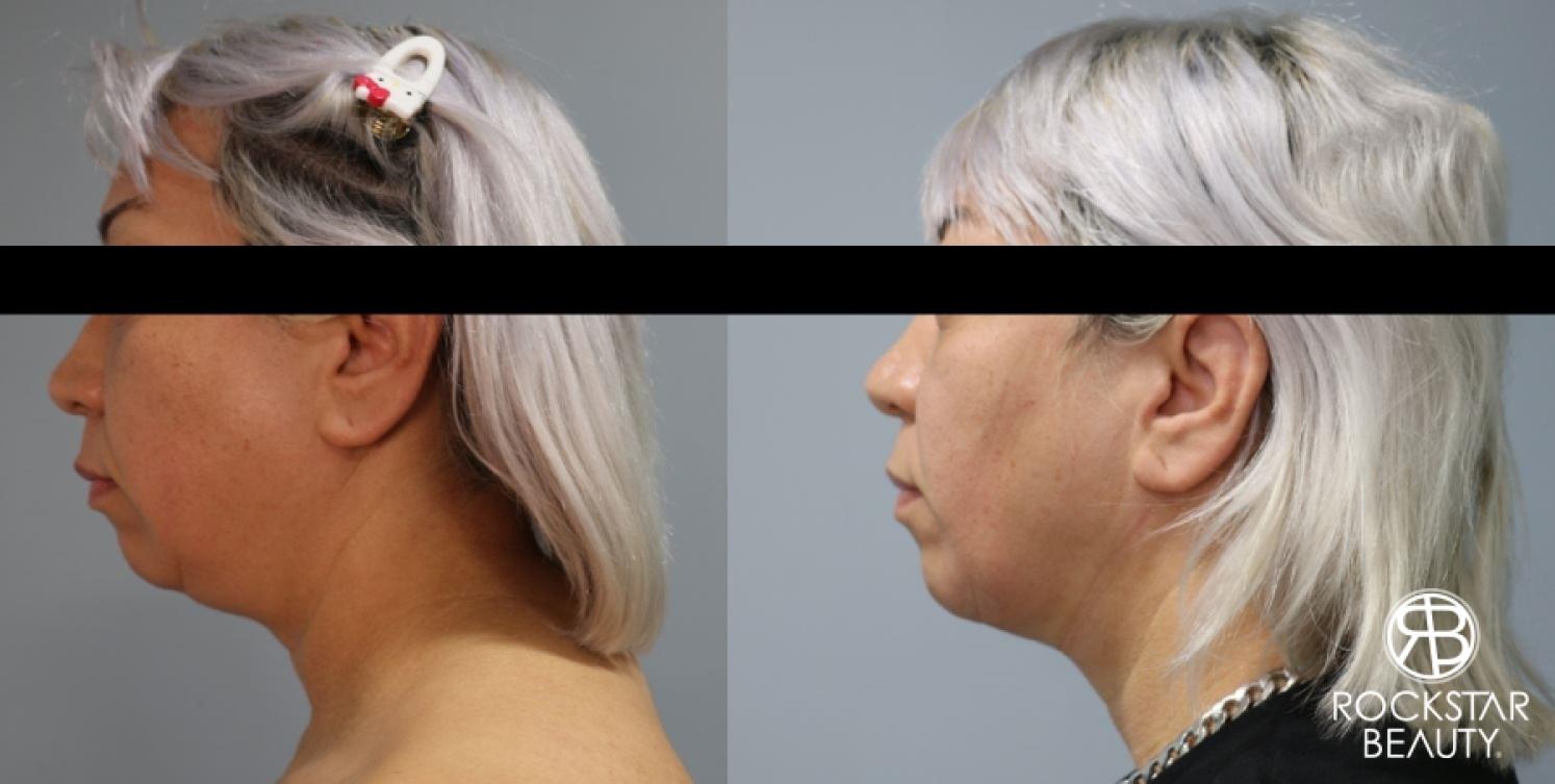 Liposuction Of The Neck: Patient 40 - Before and After 1