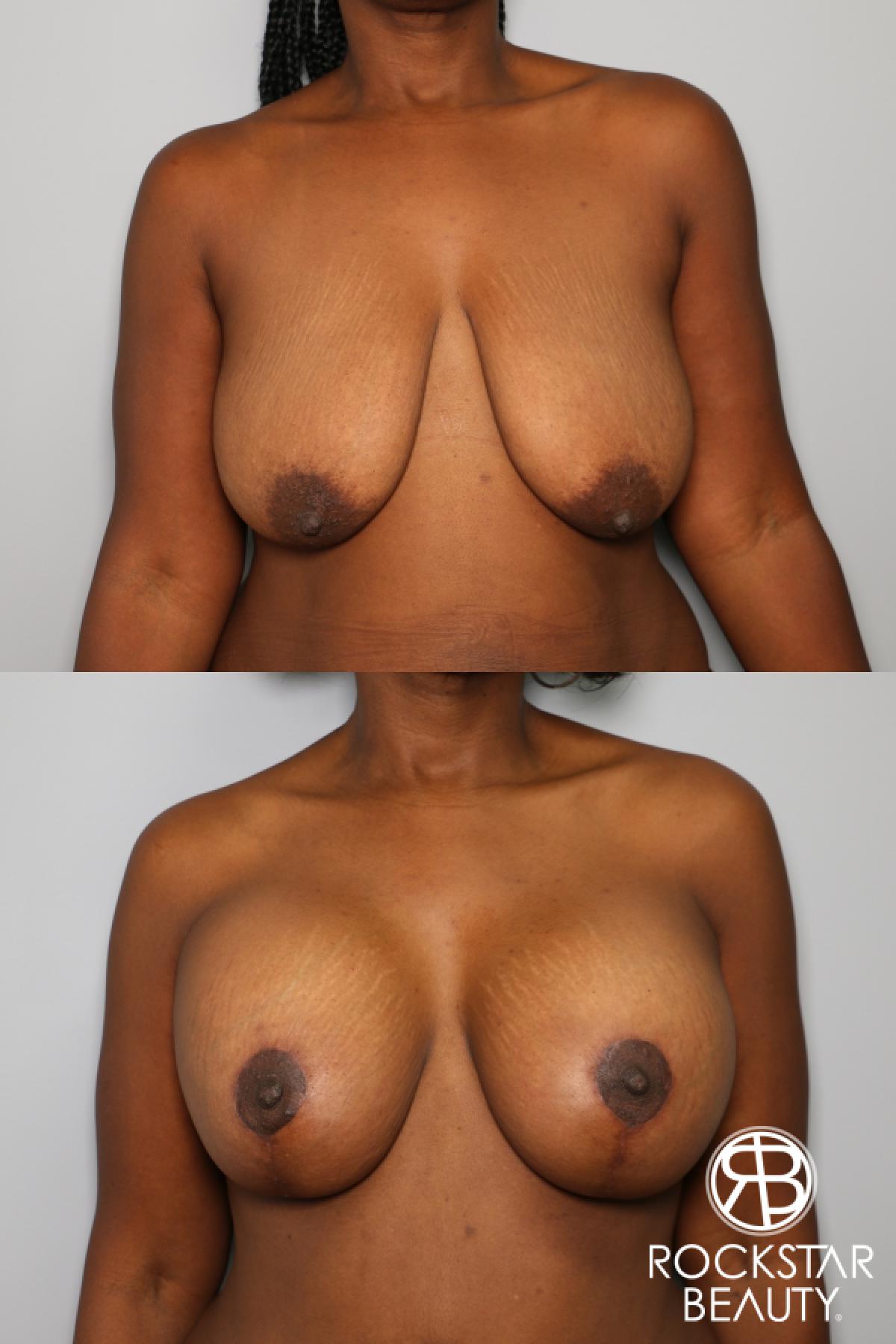 Breast Augmentation With Lift: Patient 4 - Before and After  